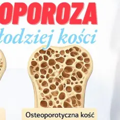 Osteoporoza: porównanie zdrowej i osteoporotycznej kości. Szkielet z zaznaczonym bólem w obrębie barku.