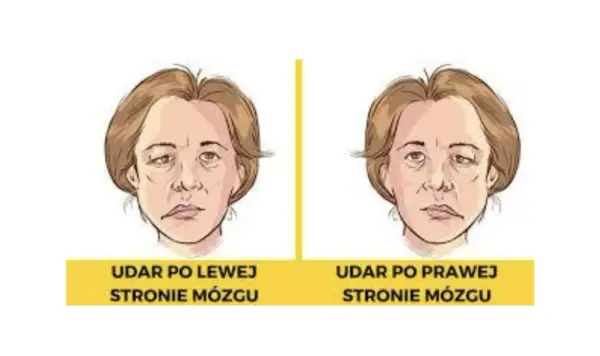 Nagły niedowład twarzy - jak odróżnić go od udaru?