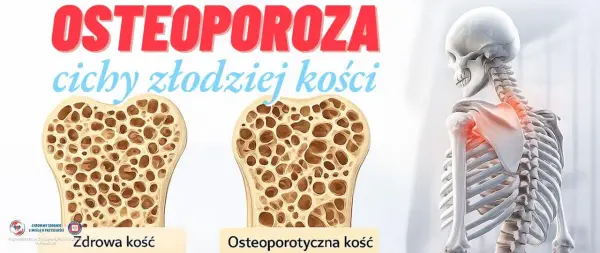Osteoporoza - cichy wróg kości. Jak uniknąć złamań?