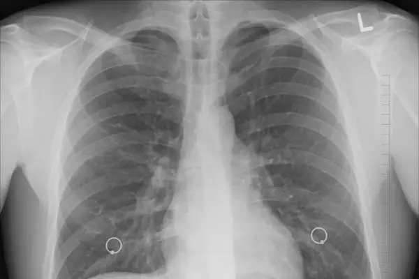 Rozedma płuc - objawy, diagnoza i co naprawdę pomaga