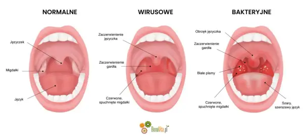 Angina bakteryjna - Czy zawsze potrzebny antybiotyk?