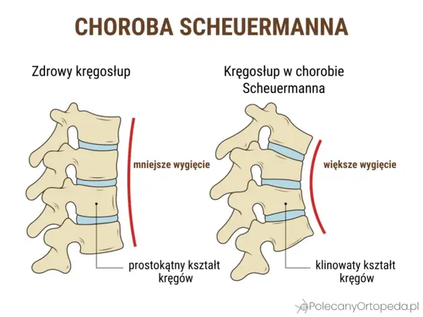 Kifoza Scheuermanna - jak ją rozpoznać i leczyć?