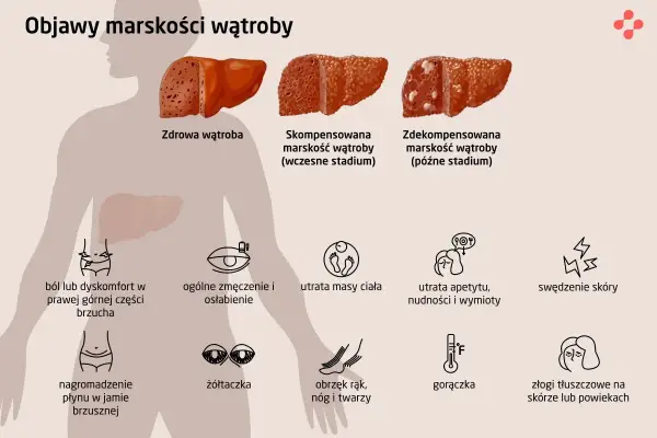 Marskość wątroby - objawy, przyczyny, leczenie. Sprawdź, co musisz wiedzieć!