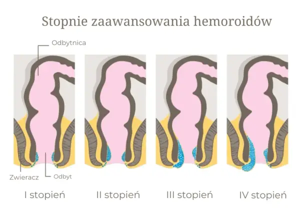 Hemoroidy - skąd się biorą i jak leczyć? Poznaj fakty!