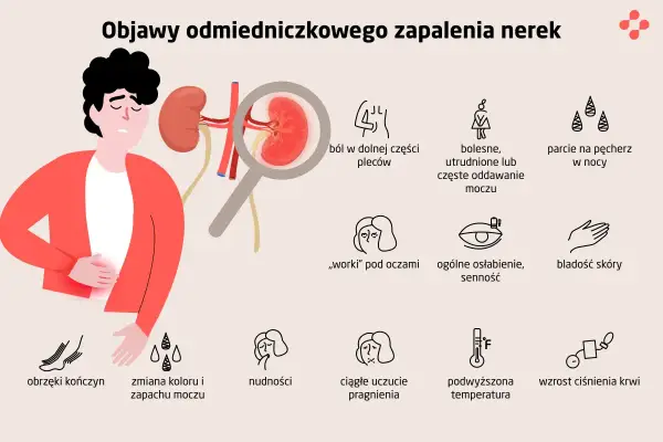 Odmiedniczkowe zapalenie nerek - Objawy, leczenie i zapobieganie
