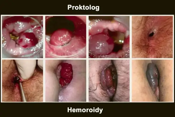 Hemoroidy zdjęcia - Czy wystarczą do diagnozy? Sprawdź!